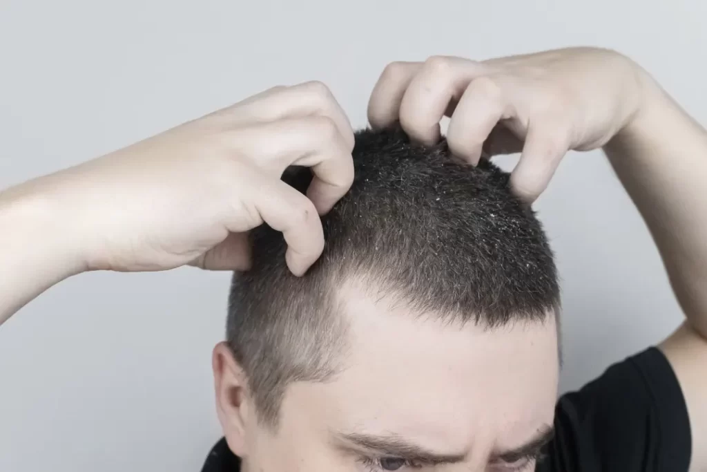 A man suffering from scalp inflammation.  