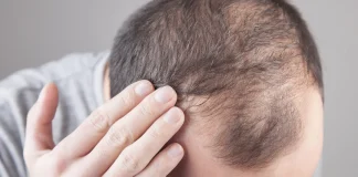 Does testosterone cause hair loss